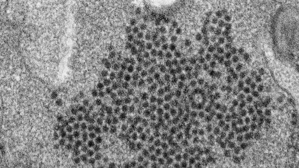 PHOTO: This 2014 file electron microscope image made available by the Centers for Disease Control and Prevention shows numerous, spheroid-shaped enterovirus-D68 (EV-D68) virions. (Cynthia S. Goldsmith, Yiting Zhang/CDC via AP, FILE)