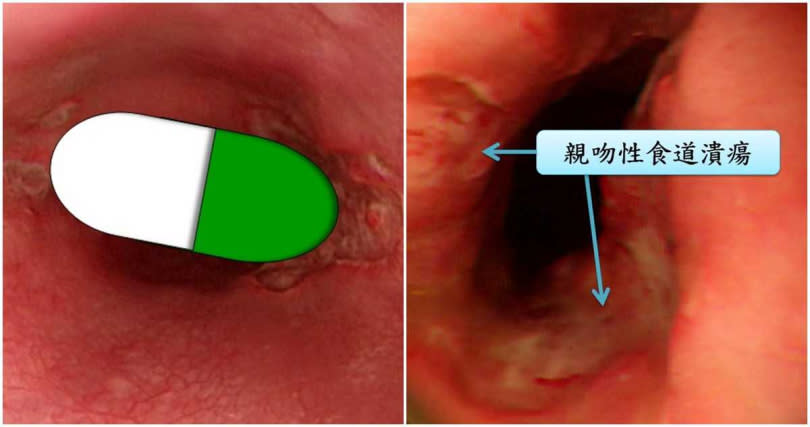 病患食道患親吻性潰瘍。