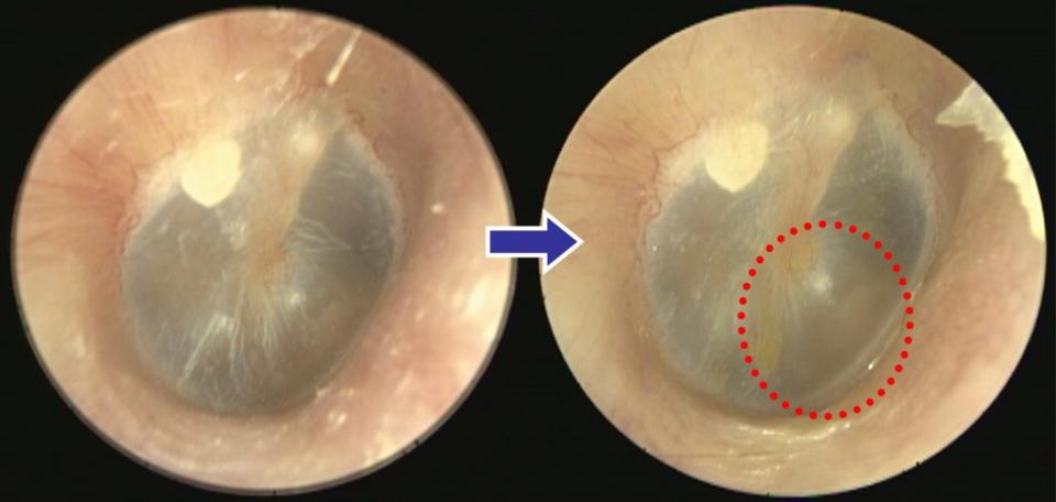 左圖為中耳炎沉積物症候群患者初診時耳膜，治療半年後，右圖紅圈處的條紋及斑點已消失，耳悶耳鳴減輕。（醫師陳建志提供）