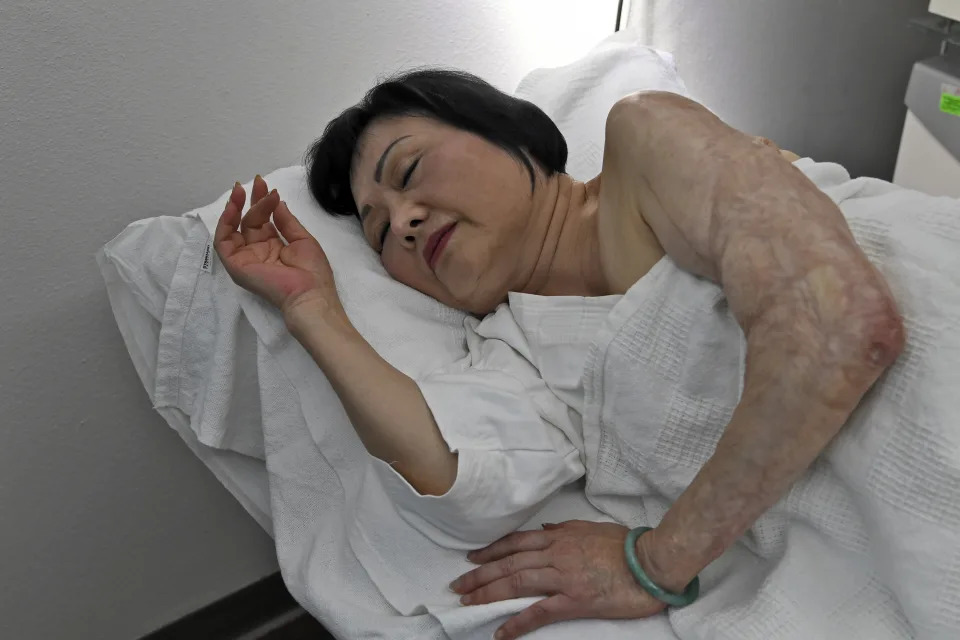 Phan Thi Kim Phuc está deitada na cama enquanto passa por tratamentos a laser nas cicatrizes deixadas por queimaduras de napalm. (Foto: Nick Ut/Getty Images)