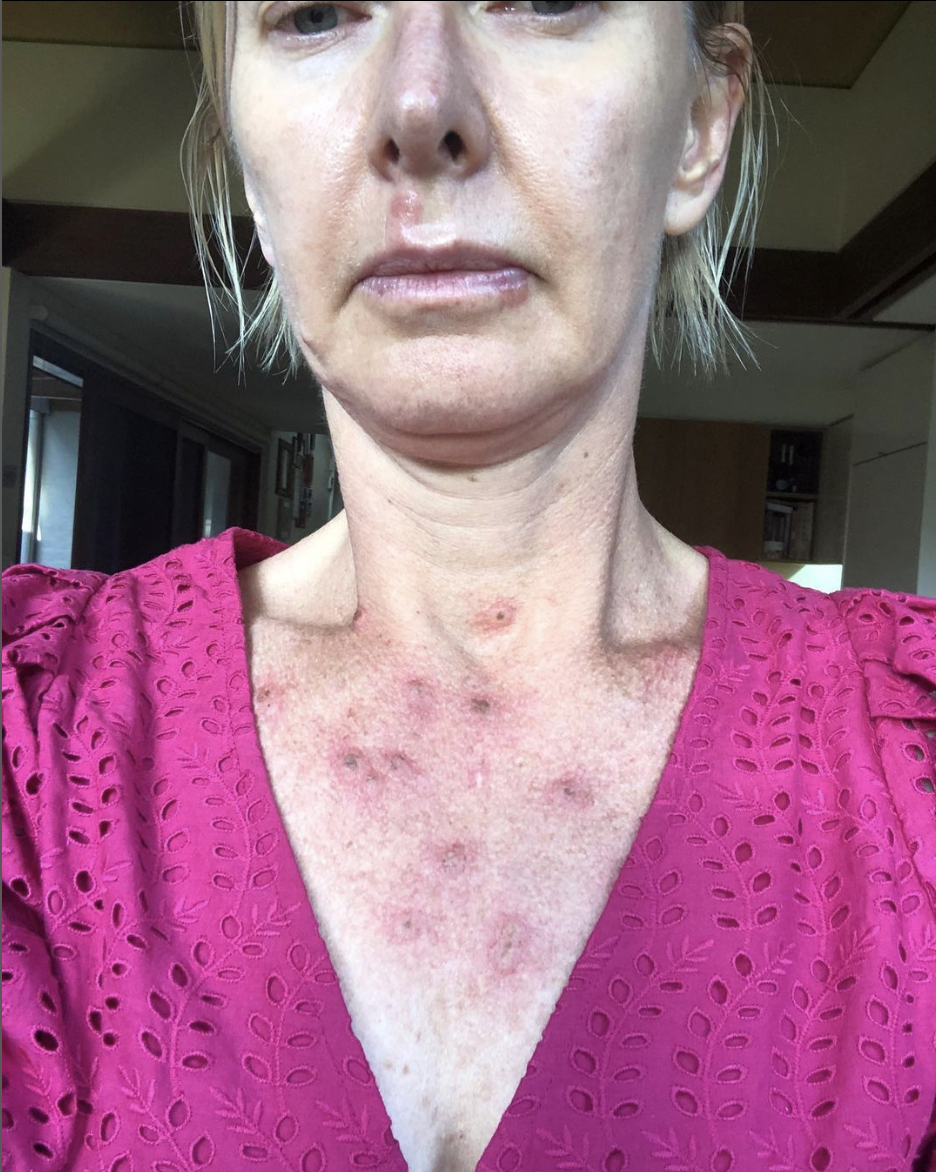 Skin cancers are seen on Deborah Knight's chest.