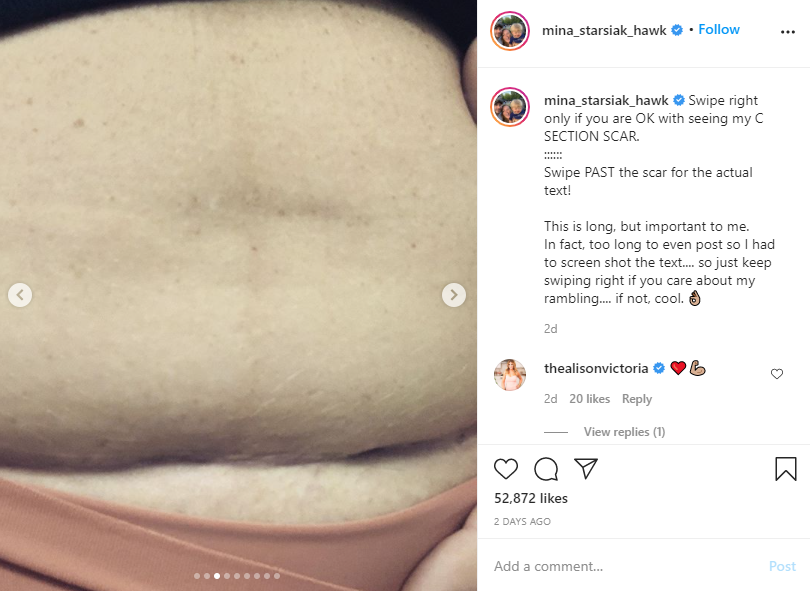 Mina Starsiak Hawk shared this photo of her post-C-section abdomen on Instagram. (Mina Starsiak Hawk / Instagram)