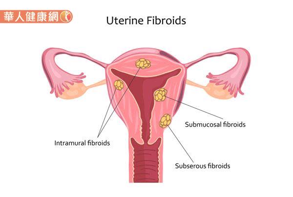 子宮其實是一個空腔，子宮肌瘤根據生長部位的不同，對人體帶來的影響也會有所差異。