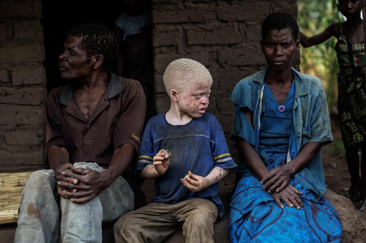 Les trois enfants devaient être vendus au Malawi, où des rituels de sorcellerie avec des albinos sont pratiqués. - GIANLUIGI GUERCIA