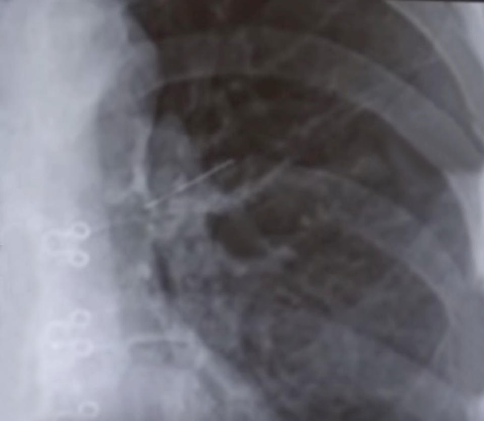 An X-ray pinpointed the cause of her terrible cough – a three-centimetre pin in her left lung. Source: AsiaWire/Australscope