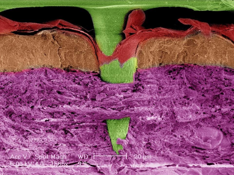 Patch vaccine microneedle enters outermost skin layers