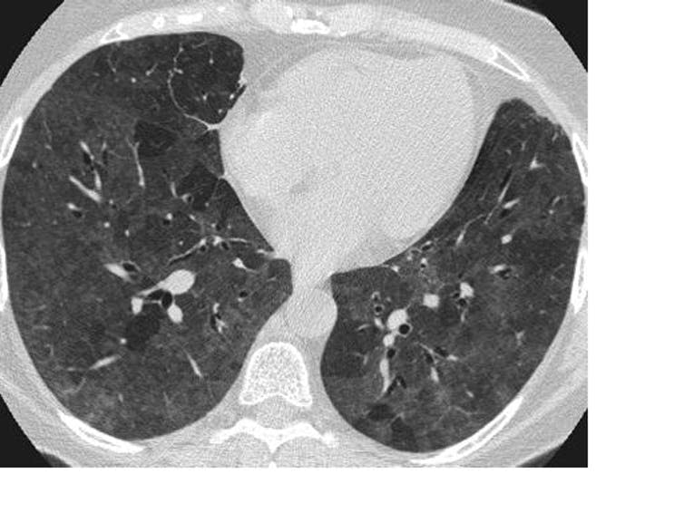 <span class="caption">CT scan showing ground-glass opacity.</span> <span class="attribution"><a class="link " href="https://commons.wikimedia.org/w/index.php?curid=9951501" rel="nofollow noopener" target="_blank" data-ylk="slk:Mluisamtz11/Wikimedia Commons;elm:context_link;itc:0;sec:content-canvas">Mluisamtz11/Wikimedia Commons</a>, <a class="link " href="http://creativecommons.org/licenses/by-sa/4.0/" rel="nofollow noopener" target="_blank" data-ylk="slk:CC BY-SA;elm:context_link;itc:0;sec:content-canvas">CC BY-SA</a></span>