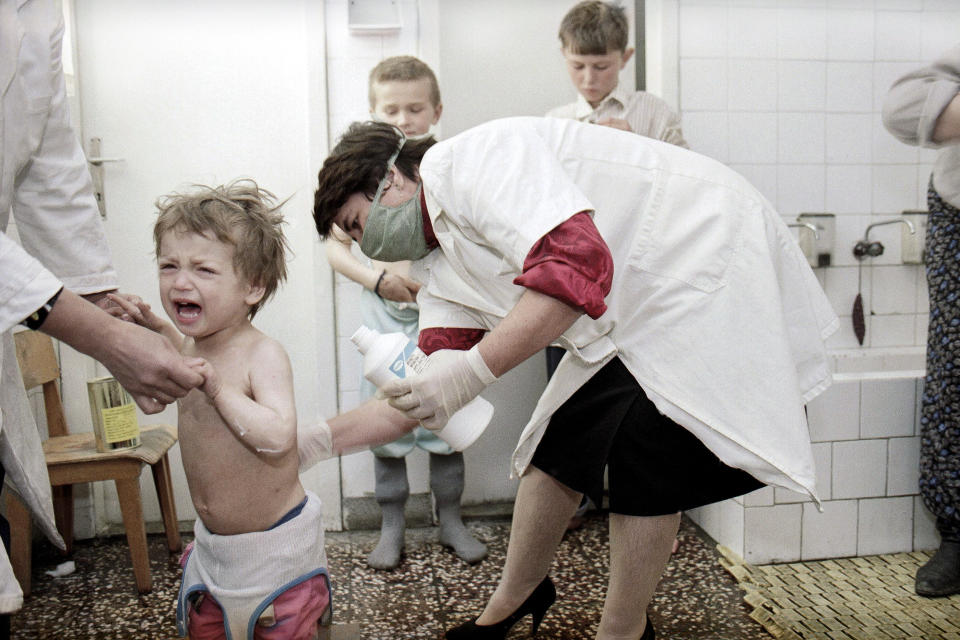 FILE- In this March 23, 1993, file picture a nurse treats a child refugee from Srebrenica with ointment against measles at the refugee camp in Lukavac, Bosnia. Survivors of the genocide in the eastern Bosnian town of Srebrenica, mainly women, will on Saturday July 11, 2020, commemorate the 25th anniversary of the slaughter of their fathers and brothers, husbands and sons. At least 8,000 mostly Muslim men and boys were chased through woods in and around Srebrenica by Serb troops in what is considered the worst carnage of civilians in Europe since World War II. The slaughter was also the only atrocity of the brutal war that has been confirmed an act of genocide. (AP Photo/Michel Euler, File)