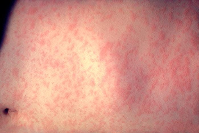 Skin rash on a patient’s abdomen 3 days after the onset of a measles infection.