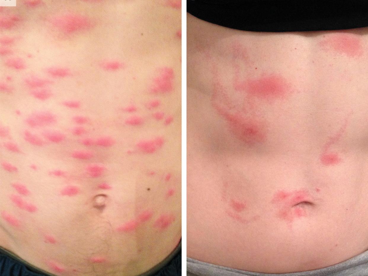 Close up images of two stomachs covered in red blotchy marks