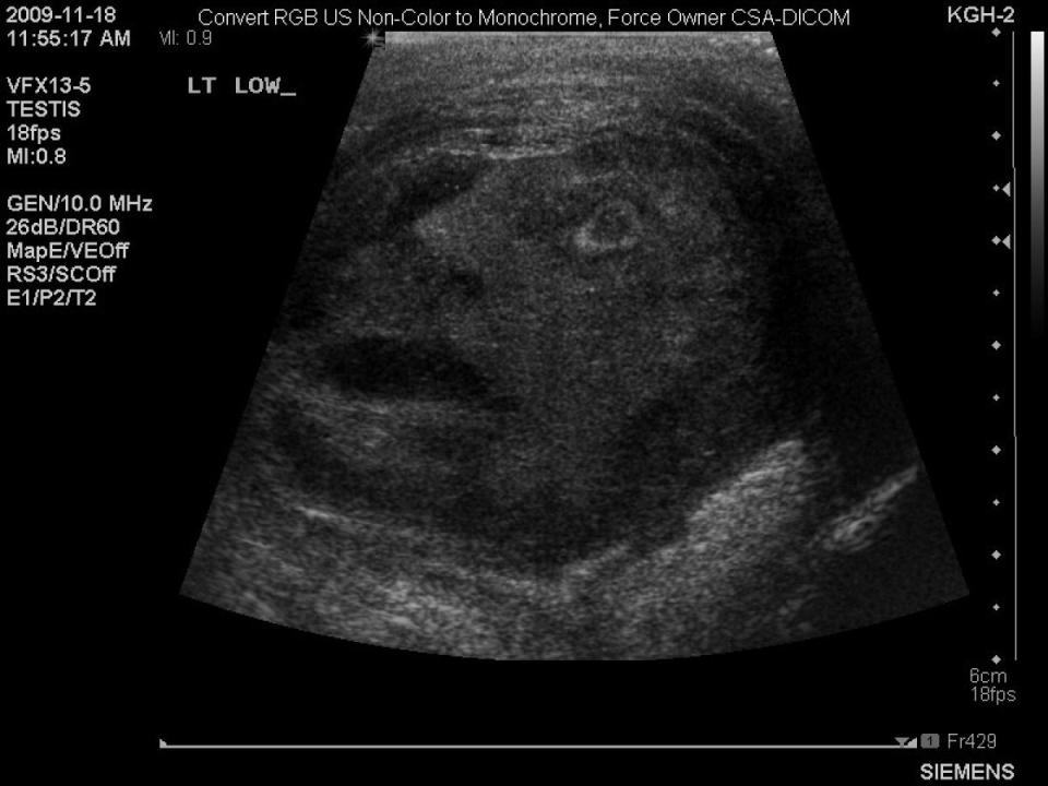 Doctors examining an ultrasound of a testicular tumor in Canada were shocked by the resemblance to a face in agony. "It was very ghoulish, like a man screaming in pain," said Doctor Naji Touma, who works at Queen's University, according to The Toronto Star. 