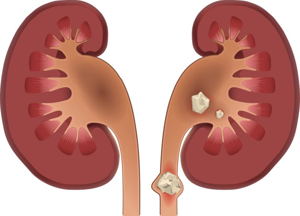 An illustration of kidney stones
