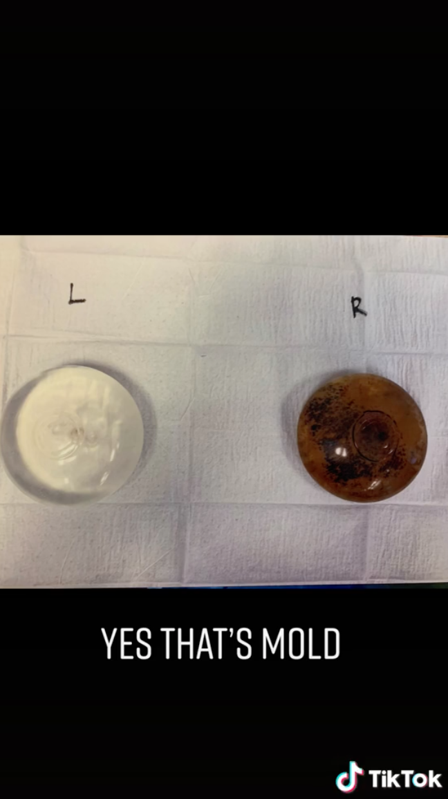 Melissa's two breast implants side by side; one is clear, the other is very dark; the caption says that the dark one looks like that because it has mold