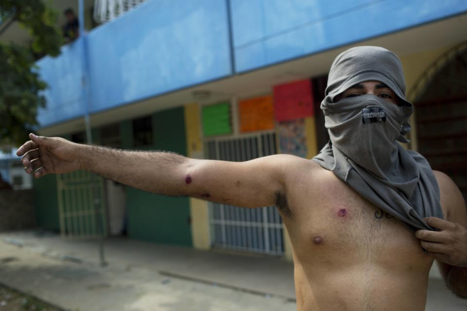 <p>A demonstrator shows injuries caused by rubber bullets fired by the police during anti-government protest in Valencia, Venezuela, on Feb. 26, 2014. The protests began with students and were soon joined by others in several cities, upset over crime, economic problems and heavy-handed government response to the protests. (Photo: Rodrigo Abd/AP) </p>