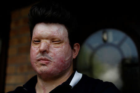 Acid attack victim Andreas Christopheros, poses for a photograph in his home in Truro, south-west England, Britain July 31, 2017. REUTERS/Peter Nicholls