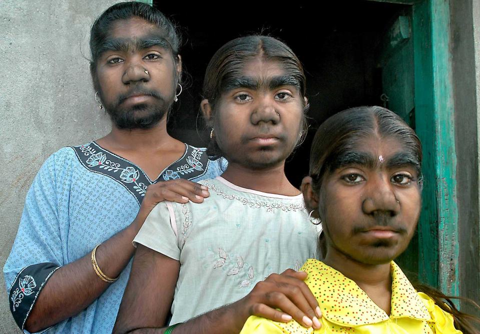 Three sisters suffer from a rare condition - werewolf syndrome. Known as hypertricosis universalis, it affects one in a billion people but all three sisters - Savita, 23, Monish 19, and Savitri, 15 - suffer from it. Hyperthrichosis is a genetic mutation where cells that normally stop hair growth in unusual areas like the eyelids and forehead are left switched on (Caters)