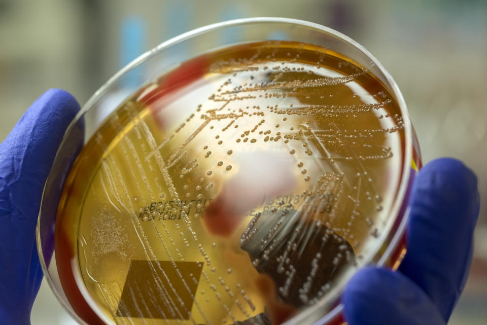 A microbiologist holding a blood agar plate showing the beta-hemolysis caused by pathogenic bacteria Streptococcus pyogenes. This bacteria can cause a variety of diseases such as scarlet fever, streptococcal pharyngitis, rheumatic fever, rheumatic heart disease, impetigo and acute postinfectious glomerulonephritis.