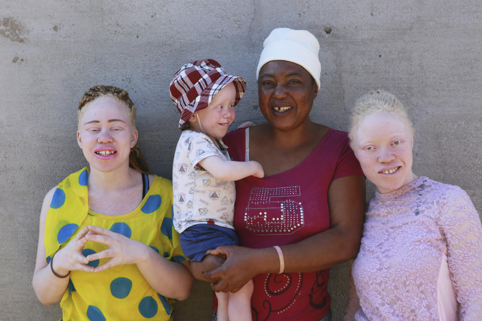 Joyce Muchenje,centre, poses for a photo with her three children, who all have albinism, outside their family home in Chitungwiza on the outskirts of Harare, in this Tuesday, June, 9, 2020. Muchenje used to provide for them by washing laundry and household cleaning for cross border traders at a busy border town before the lockdown, but now the border trade has stopped and Mutenje has run out of money to get the skin cream for her children. (AP Photo/Tsvangirayi Mukwazhi)