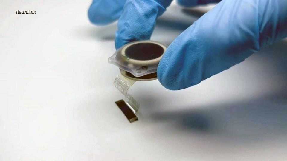 PHOTO: A Neuralink brain chip implant is handled by a scientist. (Neuralink)