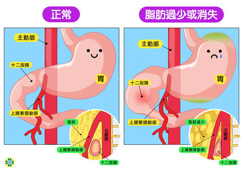 上腸繫膜動脈症候群