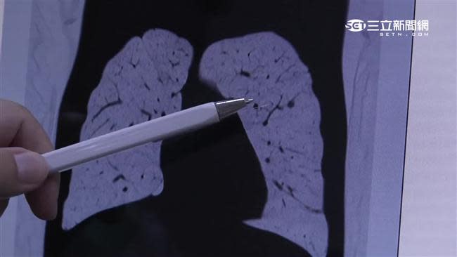 男子肺部長出11顆結節，驚慌地找醫師求助。（示意圖／資料照）