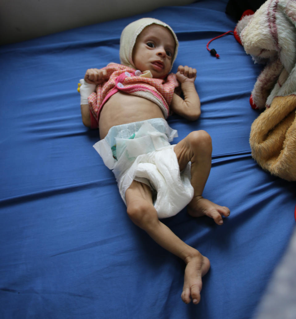 Three-month-old Ishraq Ali was diagnosed with severe malnutrition. (Photo: Ahmad Algohbary)