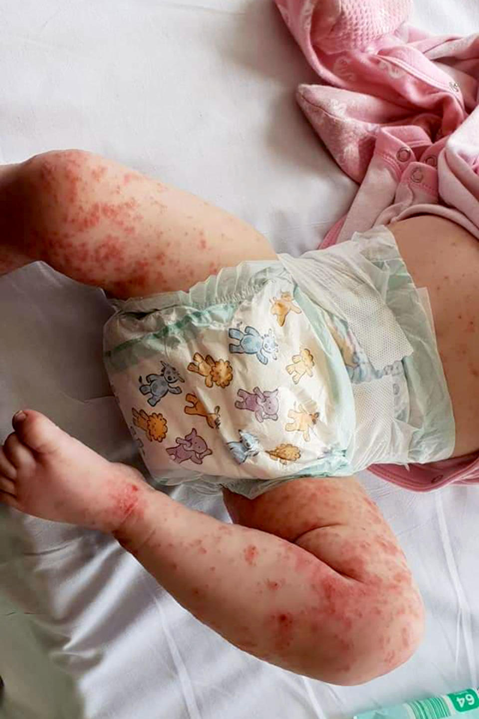 <span class="s1">The tot quickly developed an ‘awful’ purple rash all over her body. Photo: </span>Caters