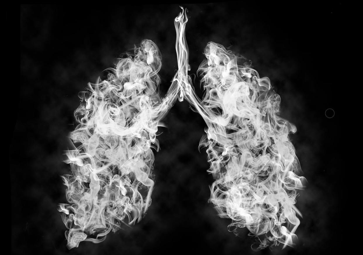 Chronic obstructive pulmonary disease is the third leading cause of death in the United States. <a href="https://www.gettyimages.com/detail/photo/illustration-of-a-toxic-smoke-in-lung-cancer-or-royalty-free-image/1179207088" rel="nofollow noopener" target="_blank" data-ylk="slk:Pascal Kiszon via Getty Images;elm:context_link;itc:0;sec:content-canvas" class="link ">Pascal Kiszon via Getty Images</a>
