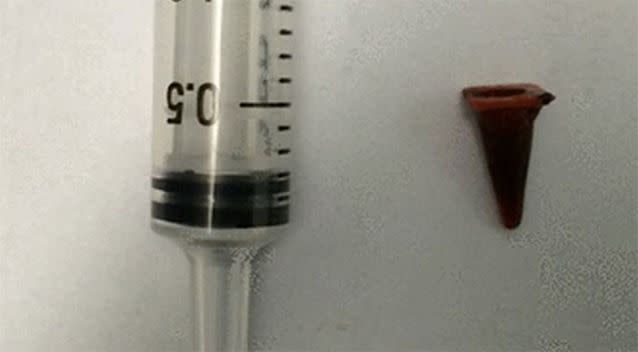 A tiny toy traffic cone was pulled from the man's lung. Source: BMJ