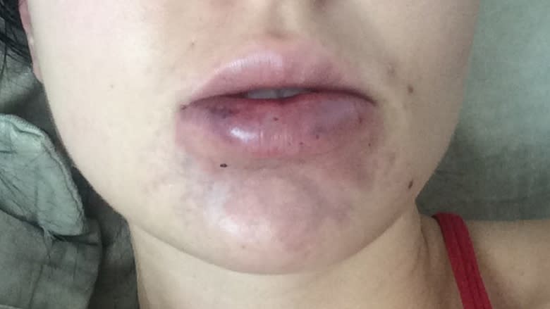 'It's just been so painful': Woman warns against lip-filler house parties after medical crisis