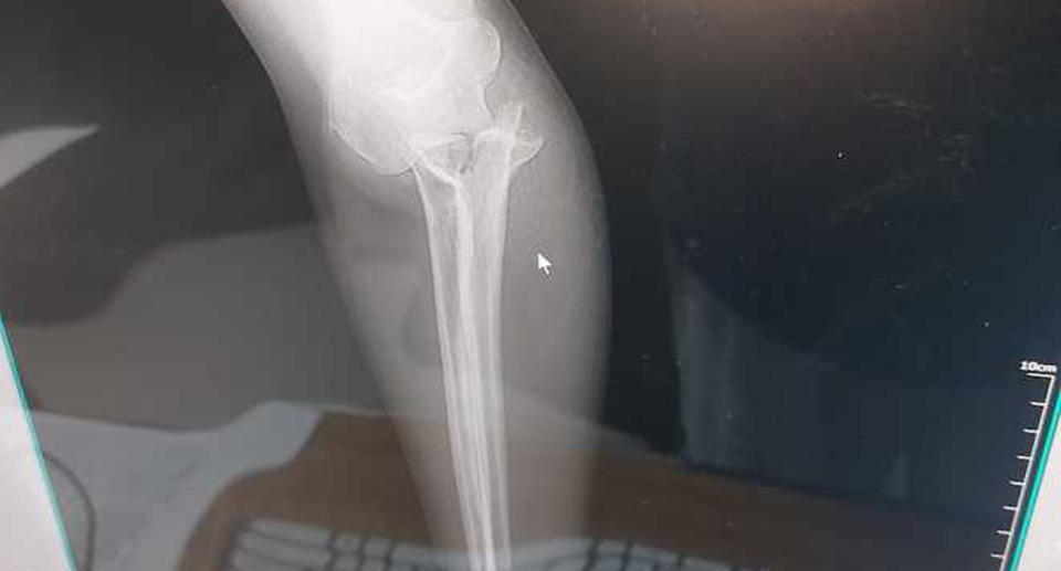 An X-ray of Beth's broken arm.