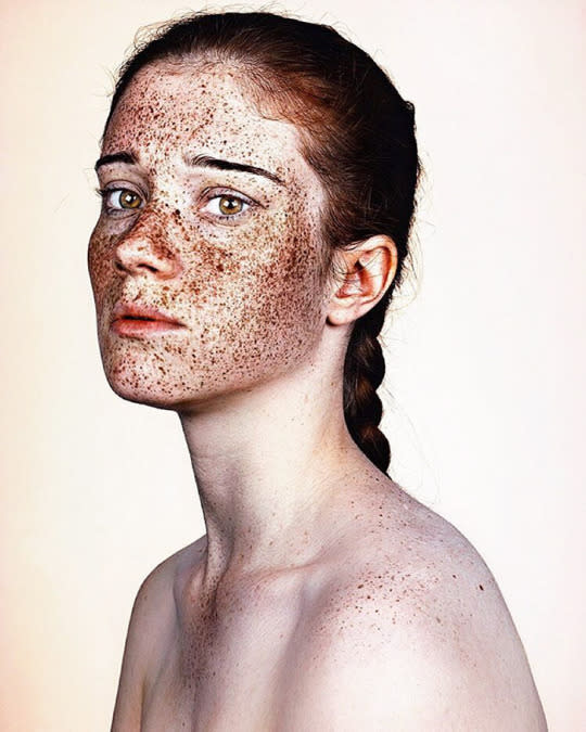 ‘I’ve always loved freckles’