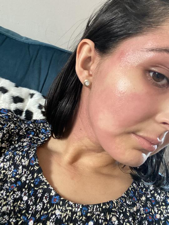 Anisha’s eczema got worse over the last year (Collect/PA Real Life)