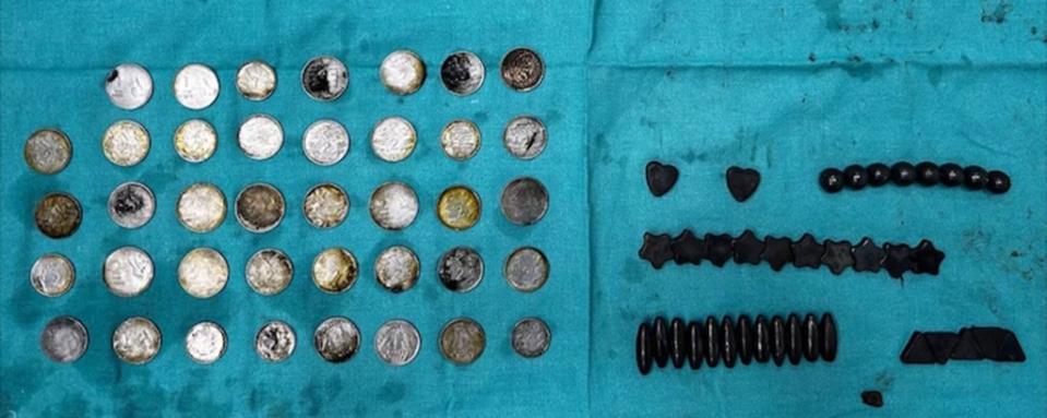 Doctors pulled out a total of 39 coins and 37 magnets from the man’s stomach and intestines. Sir Ganga Ram Hospital