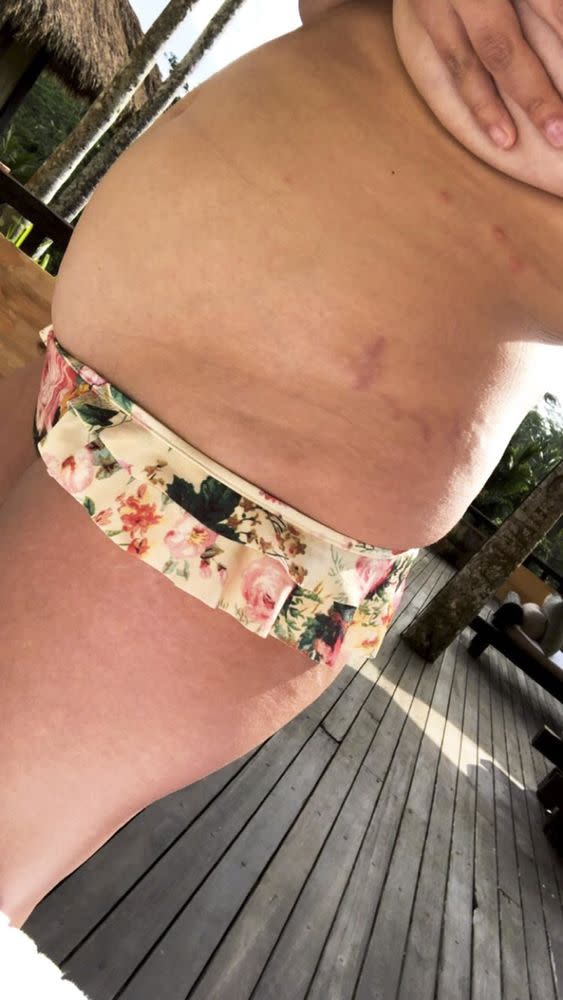 Celebrity Post-Baby Bodies: Photos of Stretch Marks, More