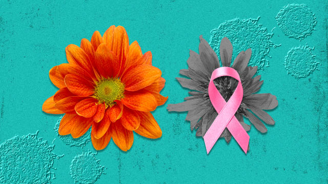 What it's like to have a single, not double, mastectomy