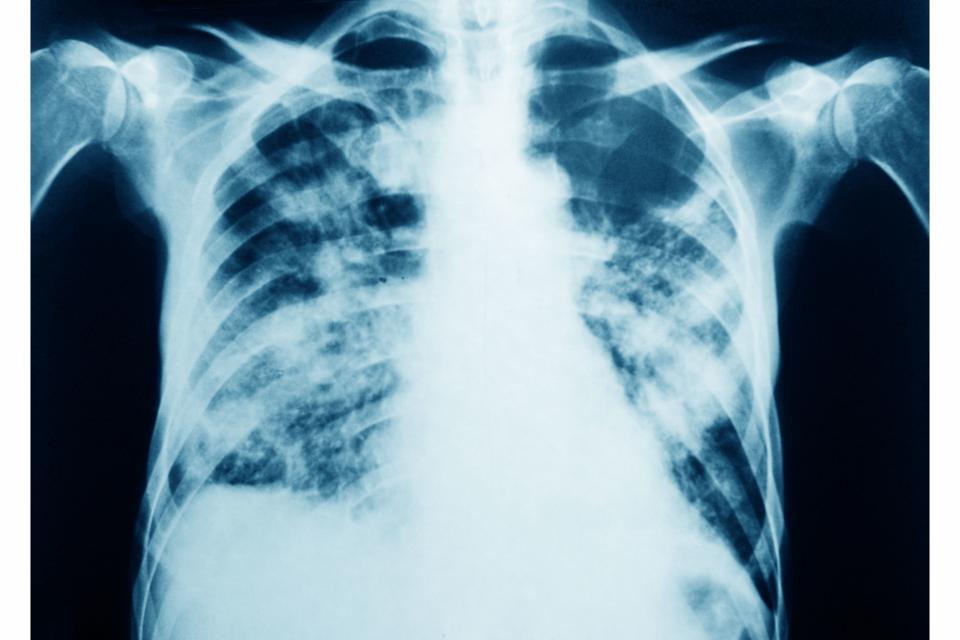 Pneumocystis pneumonia, PCP, seen on a frontal chest x-ray. (Photo by: BSIP/Universal Images Group via Getty Images)