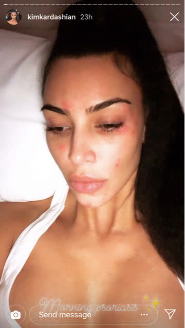 Kim Kardashian shared a candid photo of her skin condition on Sunday. (Photo: Kim Kardashian/Instagram)