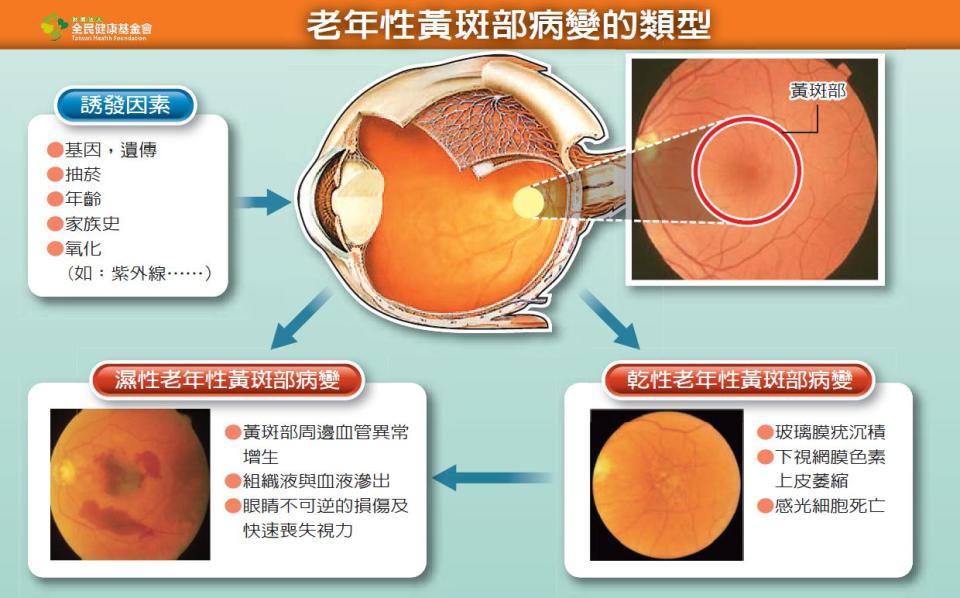 黃斑部位在眼球正後方的視網膜中心。老年性黃斑部病變依是否產生脈絡膜新生血管，分為乾性及濕性兩類型。