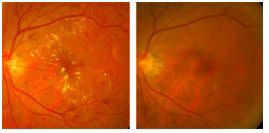 糖尿病黃斑部水腫治療前(左)、後之眼底照片比較。黃斑部黃色滲出物及眼底出血明顯減少(右)。(基隆長庚醫院提供)