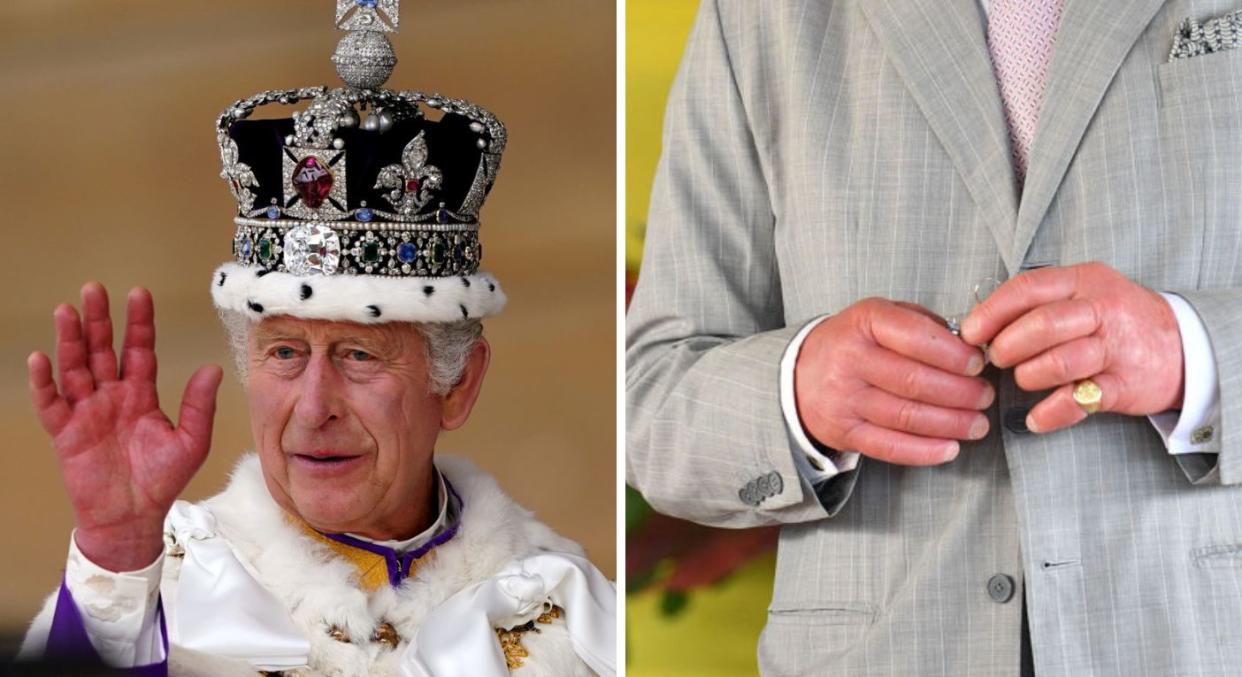 King Charles' swollen fingers have seen a spike in interest of late, particularly in the lead up to the coronation. (Getty Images)