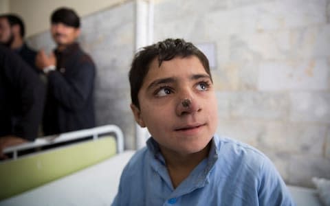 Muhammad, 10-year-old gets treated for Leishmaniasis at the Naseerullah Babar Memorial Hospital on Nov 26, 2018 in Peshawar, Pakistan.  - Credit: Saiyna Bashir /The Telegraph