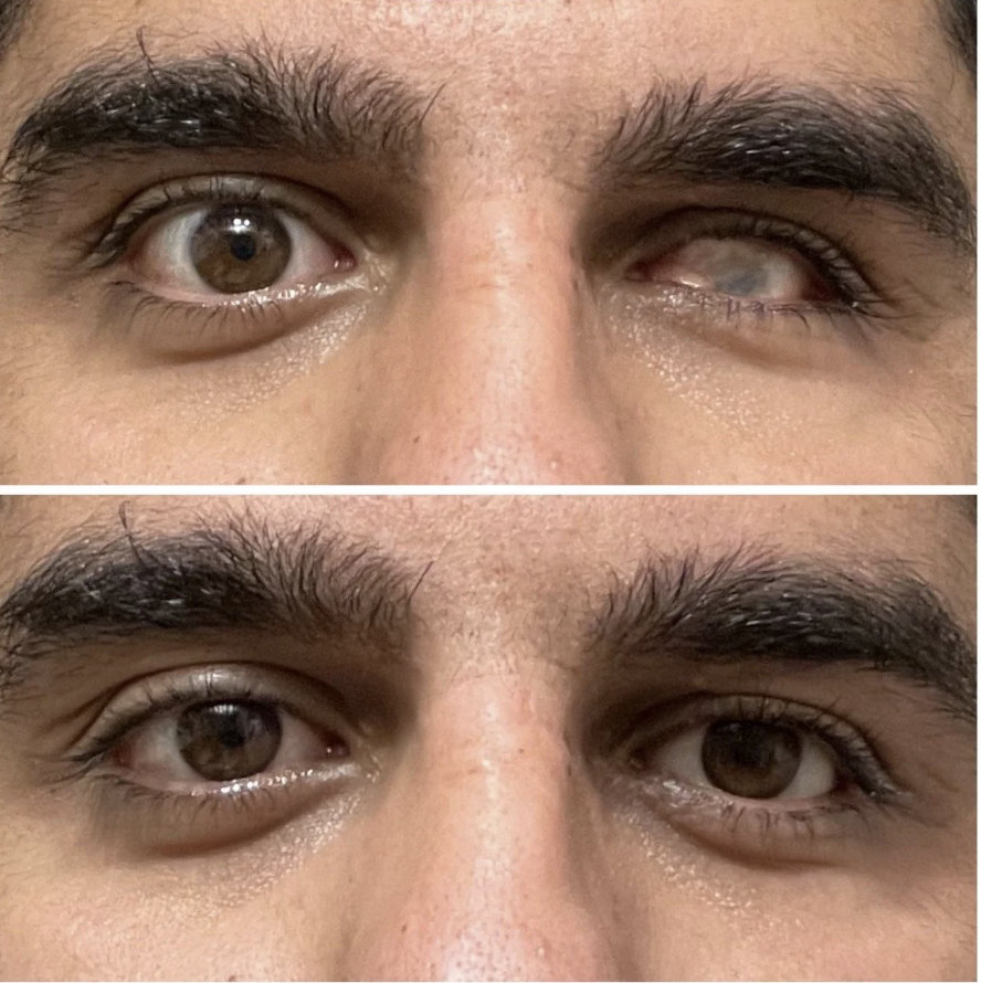 Closeup of a person's eyes showing how prosthetics improve the eye