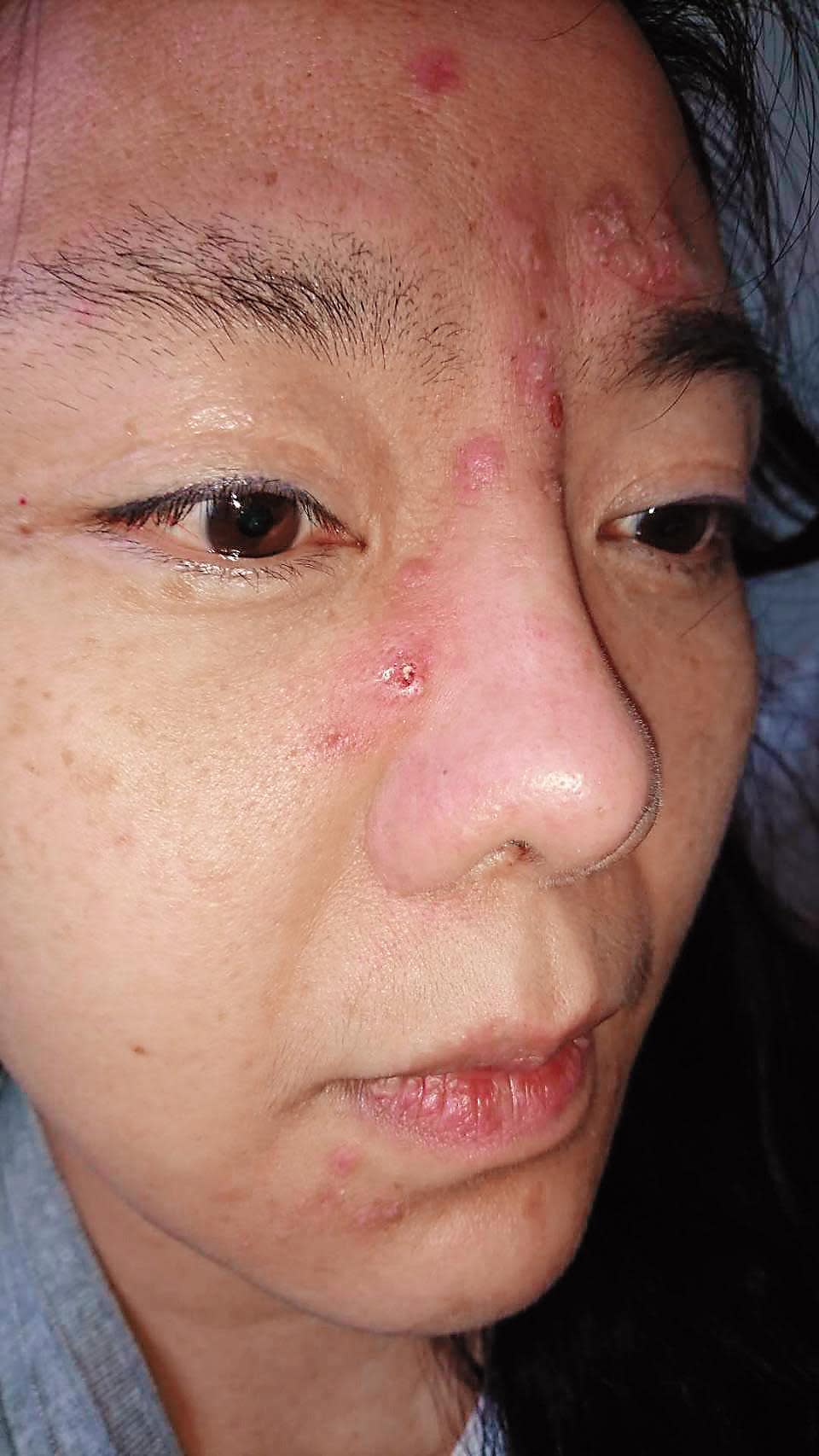 小潘潘最近傳給友人的照片，可以明顯看出長了很多痘痘，有免疫力失調跡象。（小潘潘友人提供）