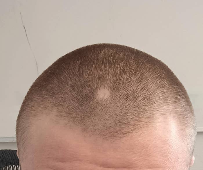 Close-up of a person's shaved head with a small spot of light in the center. The person's face is not visible.