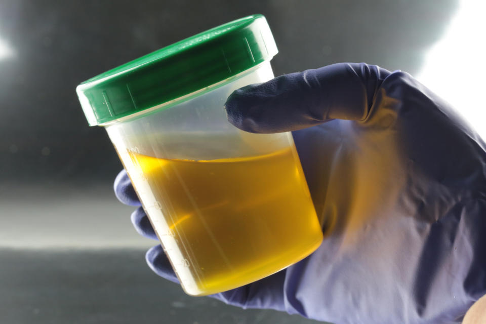 Urine sample