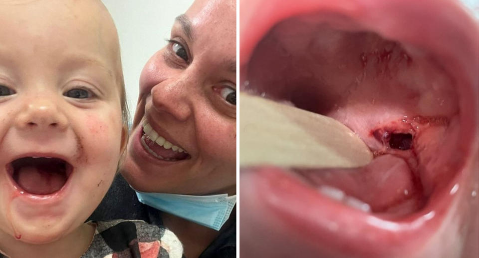 Child with hole in mouth after toothbrush injury