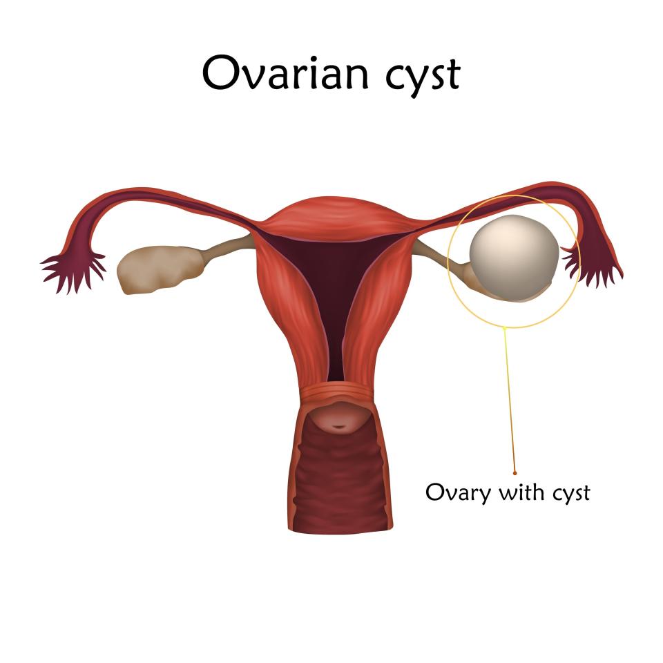 An illustrated image of the uterus and fallopian tubes with an ovarian cyst