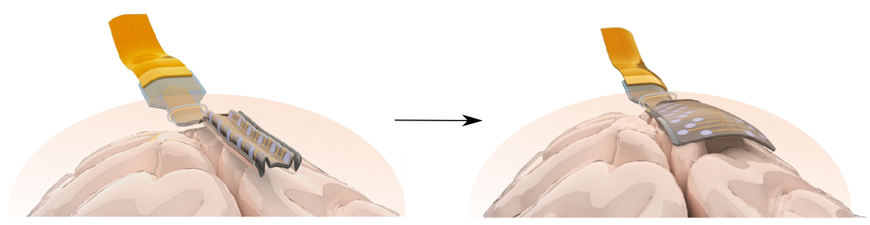 An artist's impression showing how the electrodes unfold in the brain