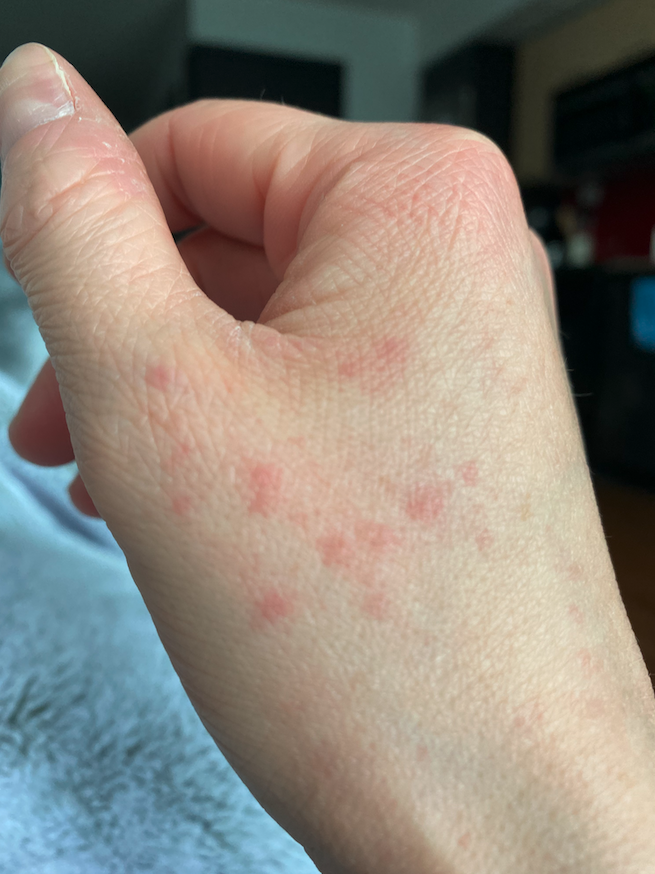  long COVID hand rash with tiny light red splotches on Julia Ranney